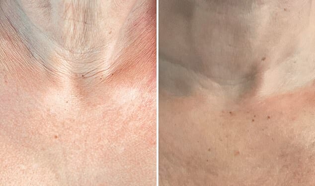 Olivia Falcon's neck when she was on Ozempic (left) and after deploying her top tips to rid the saggy skin (right)