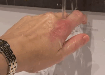 Megan McKenna shows off painful and 'blistering' injury after kitchen mishap