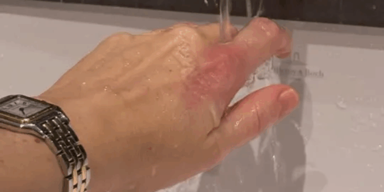 Megan McKenna shows off painful and 'blistering' injury after kitchen mishap