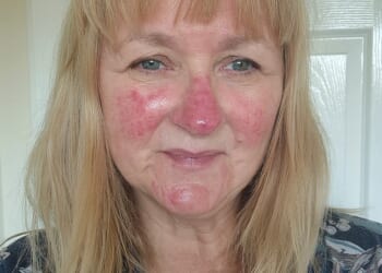 Amanda Redfern first noticed the signs of rosacea six months before her 50th birthday