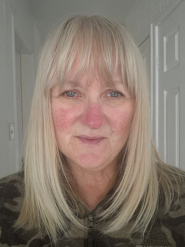 The GP couldn’t explain why she had developed it, as it can be triggered by different things, from alcohol to exercise