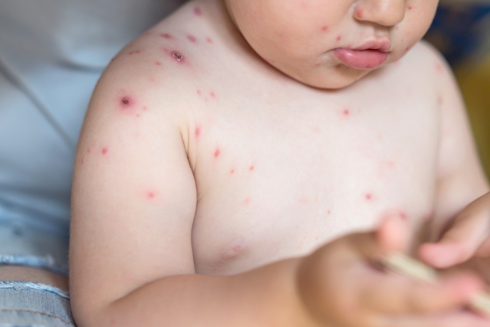 Little girl with varicella zoster virus