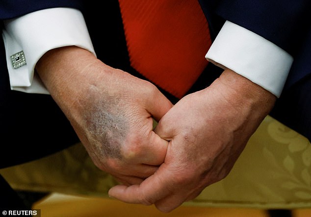 A photo last year shows bruising on the President's right hand as he attends a meeting