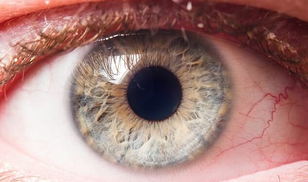 Glaucoma is usually caused by a build-up of pressure in the eye which occurs when fluid cannot drain properly