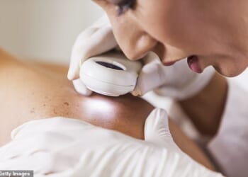 Experts warn melanoma, a type of skin cancer, is not always just on the skin (stock image)