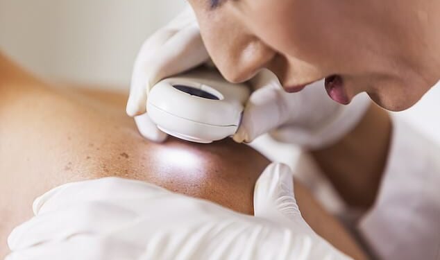 Experts warn melanoma, a type of skin cancer, is not always just on the skin (stock image)