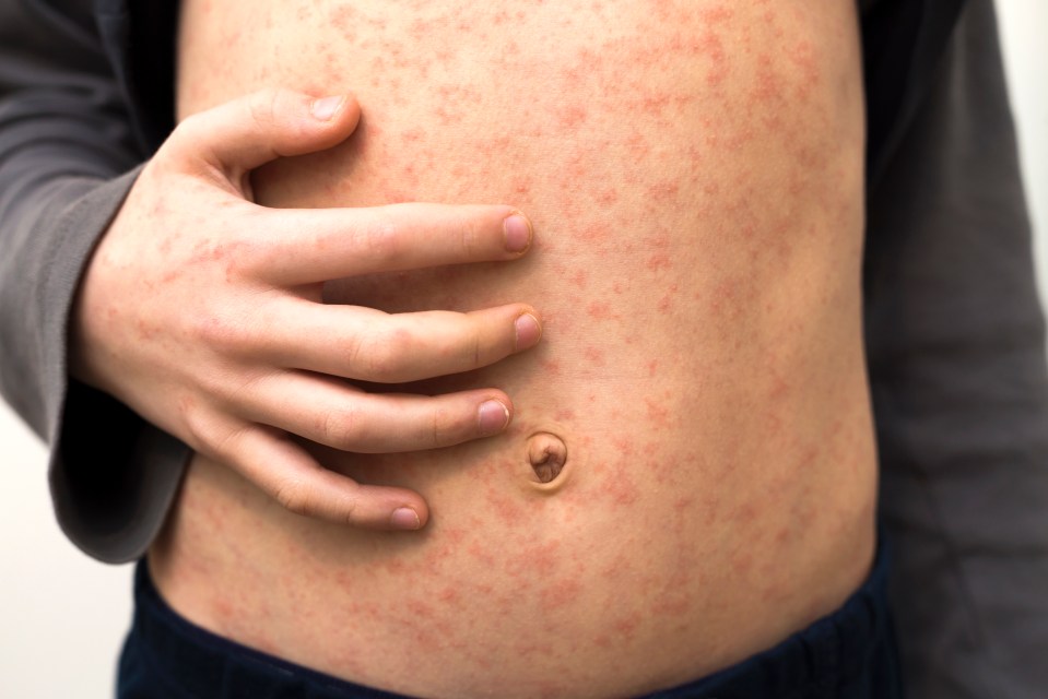 Child's torso with measles rash.