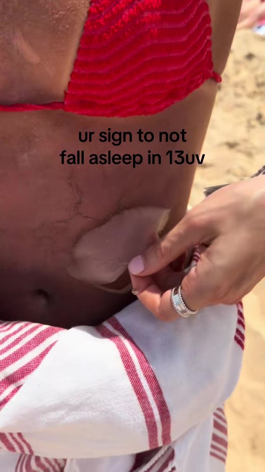 Person peeling sunburnt skin off their stomach.