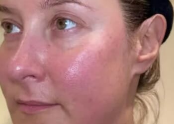 I hated my rosy pink skin so tried a £5 serum for a fortnight to see if it helped