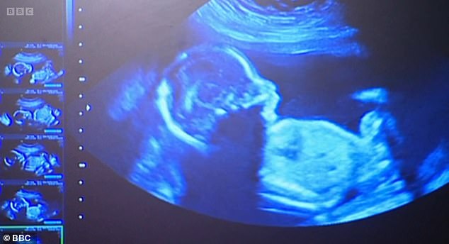 After this aired, pregnancy research charity Tommy's issued a statement in response to the advice given