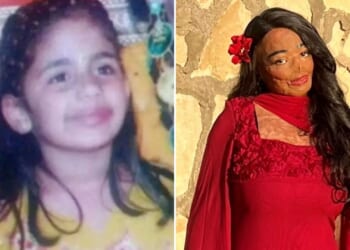 I suffered third-degree burns after using lice shampoo