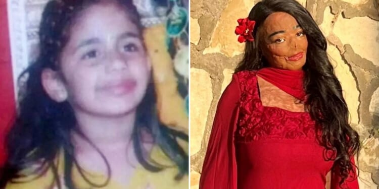 I suffered third-degree burns after using lice shampoo