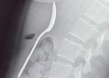 Woman issues warning about eating on your lap while dogs are around after playful pup caused her to SWALLOW 17cm spoon