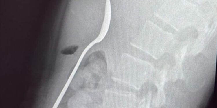 Woman issues warning about eating on your lap while dogs are around after playful pup caused her to SWALLOW 17cm spoon
