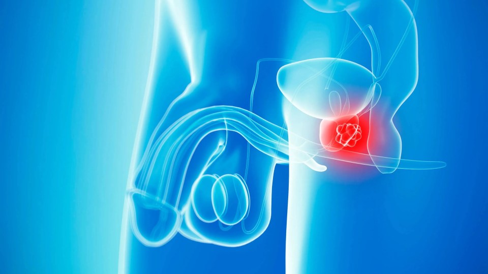 Prostate cancer, artwork