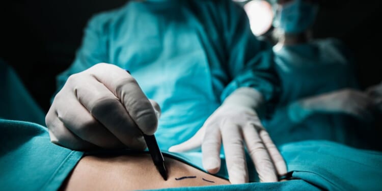 A close-up of a plastic surgeon marking the human skin for surgery.