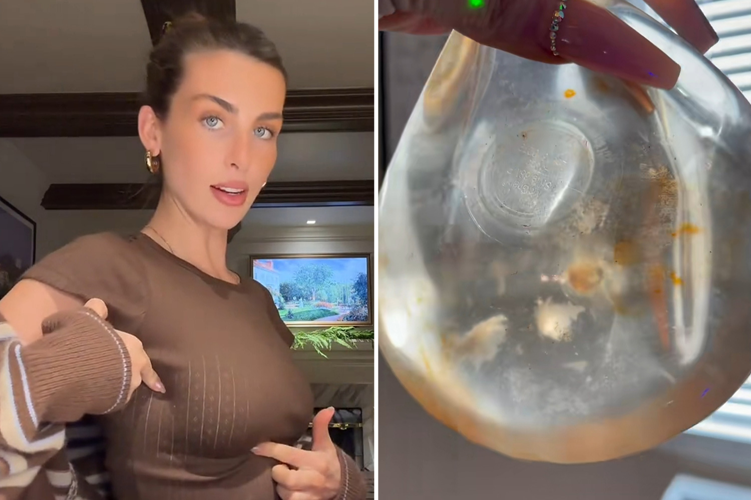 Collage of a woman pointing to her chest and a close-up of a murky breast implant.