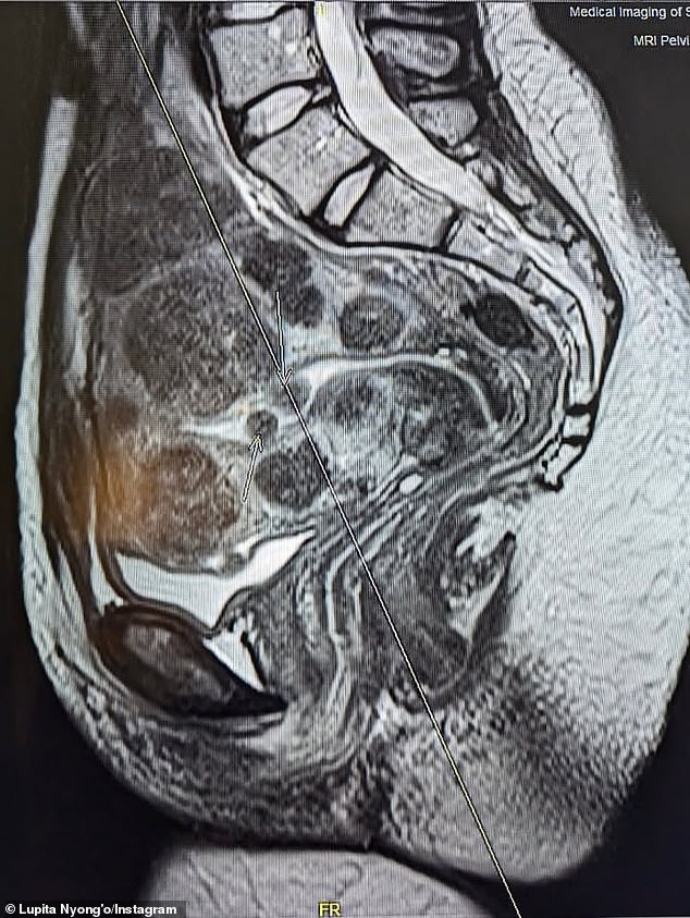 Nyong'o explained to her 11.3 million followers about her current health status, adding an image of an MRI she had done to provide a visual aid