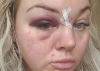 Scots mum reveals horror injuries after evil brute left her for dead in front of young son