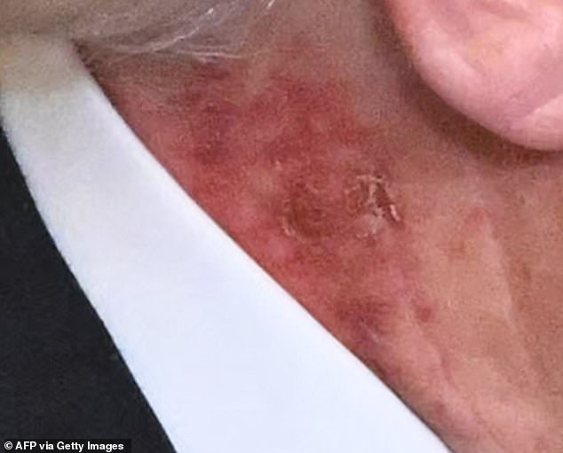 The skin behind the President's right ear appeared to be scabbed and flaking as he handed awarded the Medal of Honor to veterans at the White House