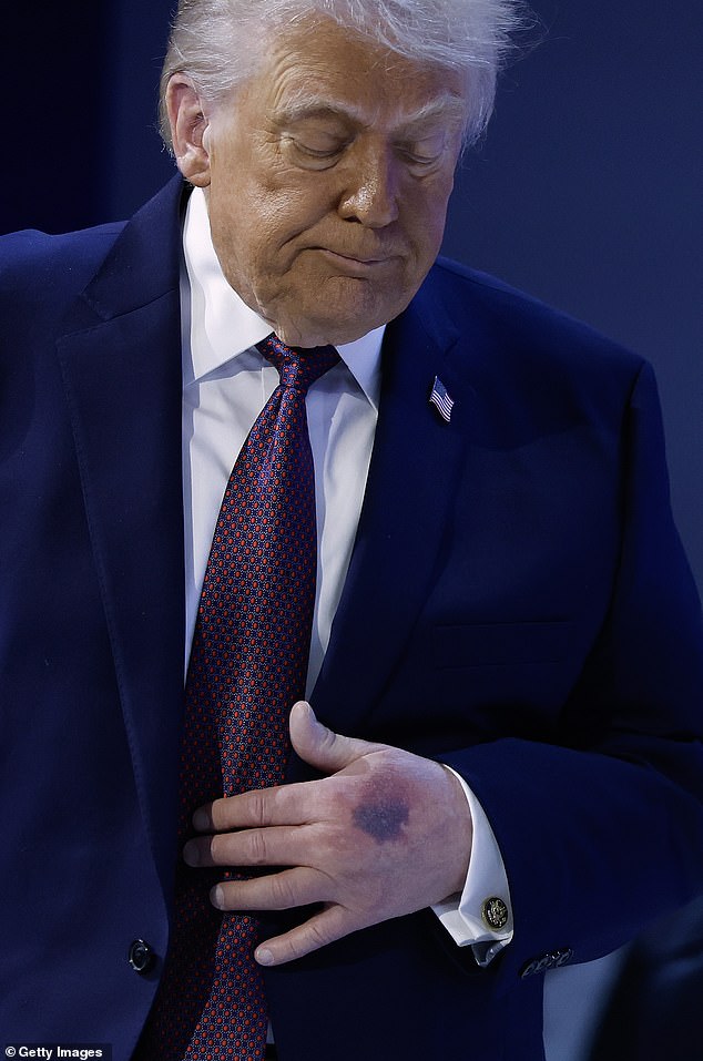 : A bruise can be seen on the back of U.S. President Donald Trump's left hand during a signing ceremony for the "Board of Peace" at the World Economic Forum (WEF) on January 22, 2026 in Davos, Switzerland