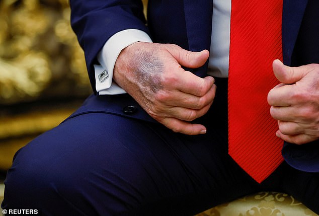 A bruise on a hand of U.S. President Donald Trump is seen during a meeting with South Korean President Lee Jae Myung at the Oval Office, at the White House, in Washington, D.C., U.S., August 25