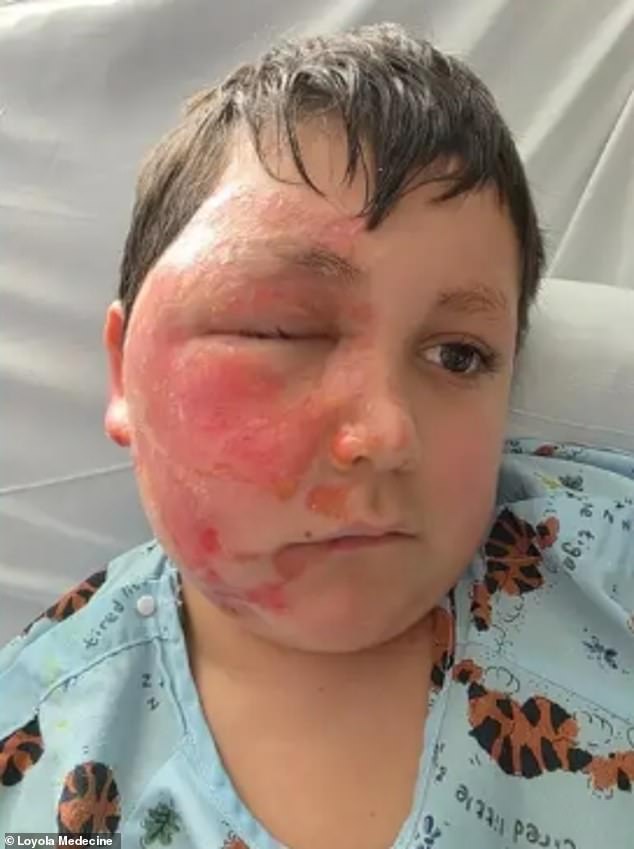 Nine-year-old Caleb was left with severe burns to his face after he took part in a dangerous TikTok trend on January 20
