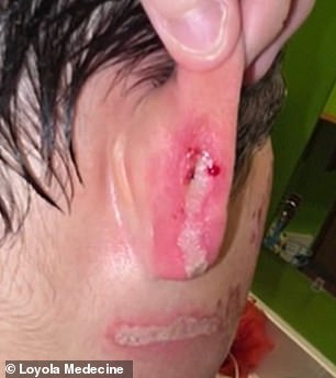 He was also left with a burns behind one of his ears
