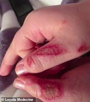 Painful burns are seen on Caleb's fingers after the toy erupted