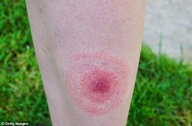 Within 3 days to a month, a red, bull's-eye rash will appear in 70 to 80 percent of cases involving a tick bite