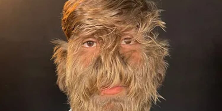 I have world’s hairiest face thanks to rare 'werewolf syndrome'