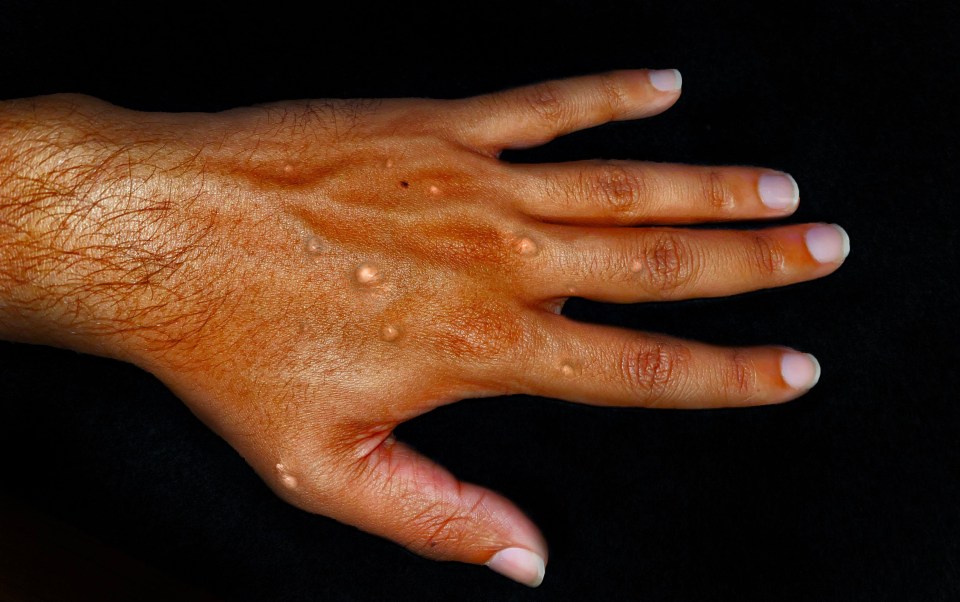 A photo of mpox blisters on a person's hand.