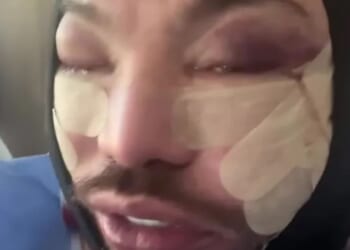 Towie’s Bobby Norris shows off swollen and bruised face after face and neck lift