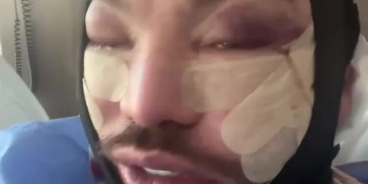 Towie’s Bobby Norris shows off swollen and bruised face after face and neck lift