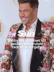Towie’s Bobby Norris shows off swollen and bruised face after face and neck lift