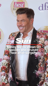 Towie’s Bobby Norris shows off swollen and bruised face after face and neck lift