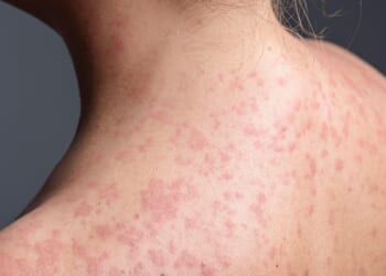 Measles rash ‘hard to spot’ in kids as GPs chase major outbreak