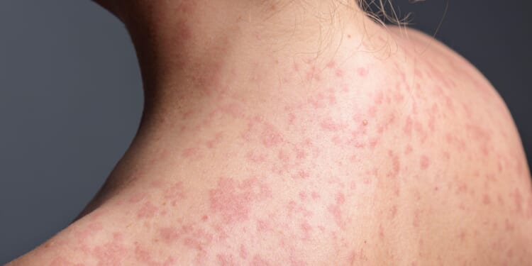 Measles rash ‘hard to spot’ in kids as GPs chase major outbreak