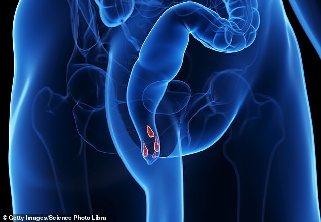 Haemorrhoids occur when blood vessels in the anal cushions - three soft, fleshy pads of tissue inside the anal canal that help control faecal continence - become swollen