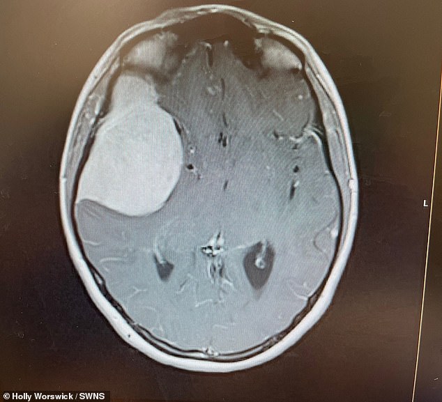 The opticians performed an optical coherence tomography (OCT) scan of the back of her eye and found that Ms Worswick's optic nerve on the right side was four times larger than it should have been