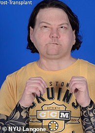 DiMeo is seen above after his face and double hand transplant at NYU Langone