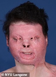 DiMeo is pictured above after waking up from a coma. He had lost 80 percent of his skin