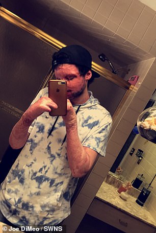 DiMeo is pictured after the accident and before the transplant