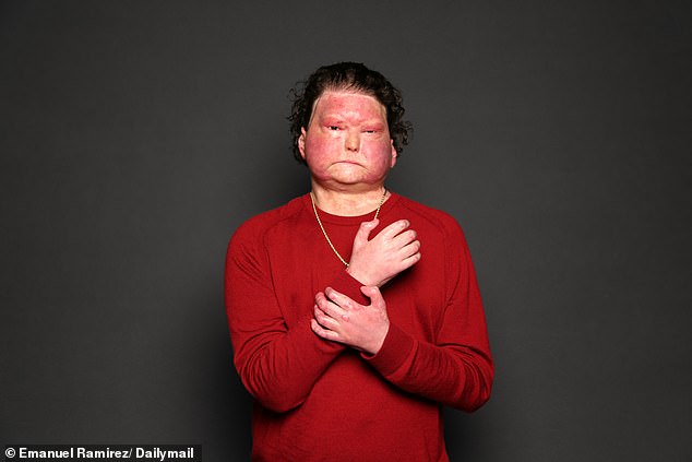 DiMeo, pictured above at age 27, received his transplant from a 47-year-old man from Rhode Island. It was the first time a face and double hand transplant had been successful