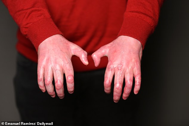 DiMeo is still working on his mobility with his new hands, but he hopes to be back lifting weights with the help of custom wrist guards