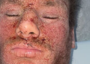 Common skin cream left me with horrific oozing wounds