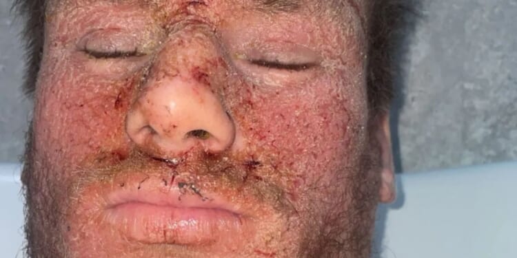 Common skin cream left me with horrific oozing wounds