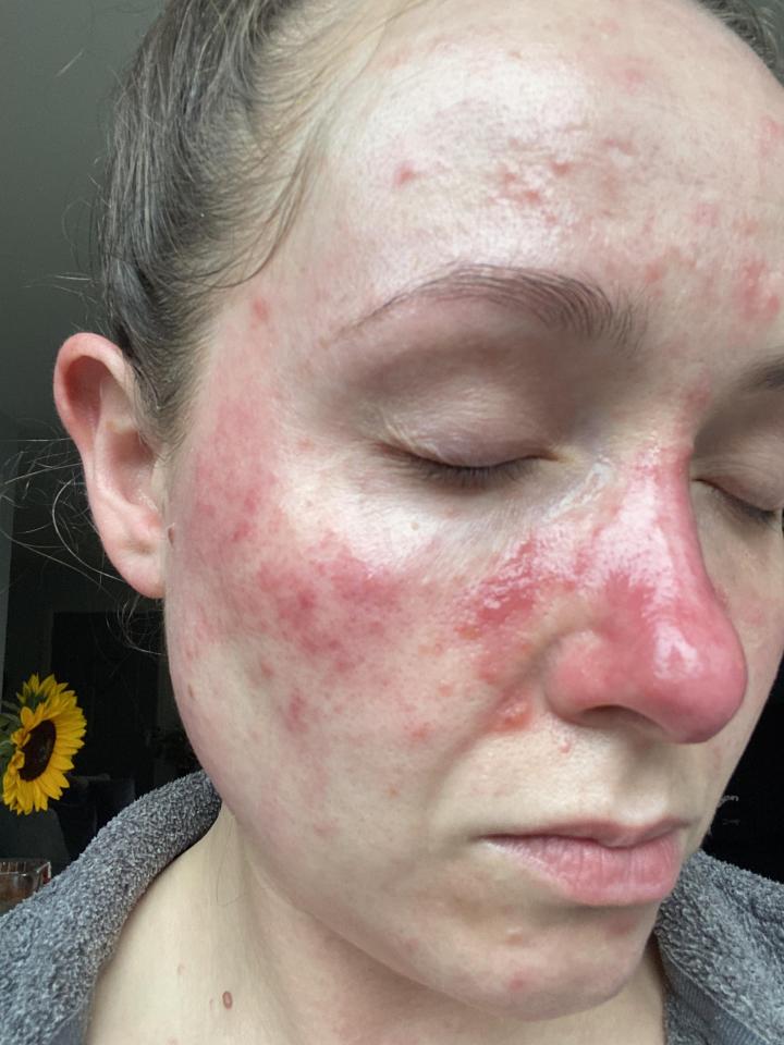 Close-up of a person's face showing skin flare-ups.