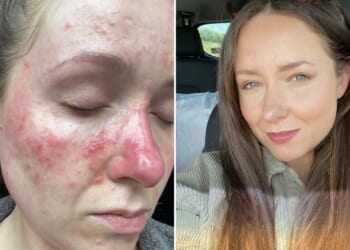 I couldn’t even open the blinds without makeup thanks to my raw, burning acne