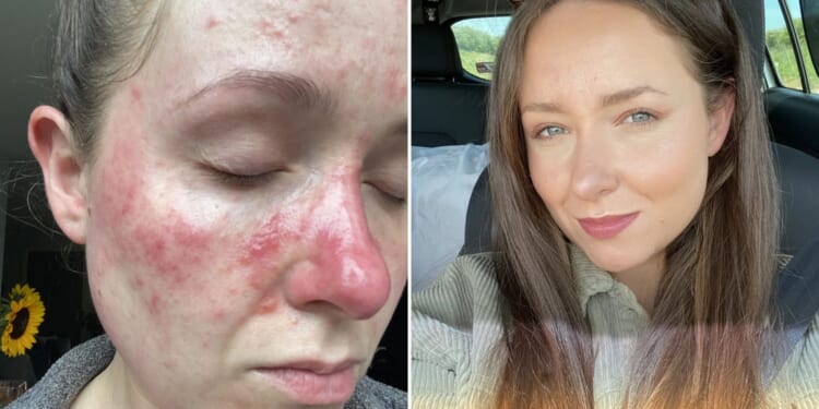 I couldn’t even open the blinds without makeup thanks to my raw, burning acne